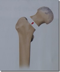 Hüftgelenk_Klein (1)